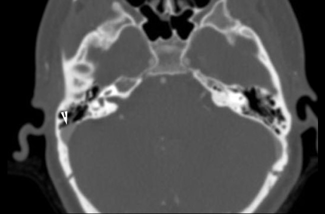 An axial CT venogram demonstrating a right SSD (white arrowhead).